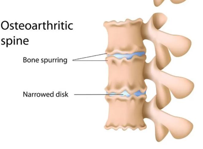 Osteoarthritic spine