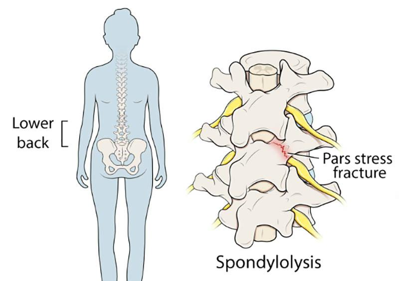 Spondylolysis - Fracture of the Pars Interarticularis