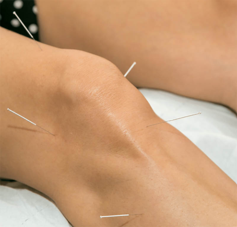 Estim with Dry Needling or No?

